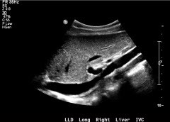 Right lobe of liver.