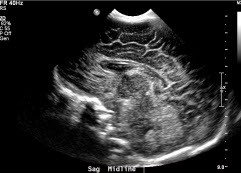 Neonatal brain.