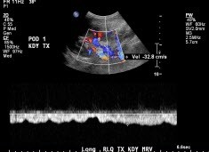 Main renal vein in kidney transplant.