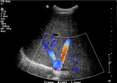 Hepatic veins emptying into inferior vena cava.